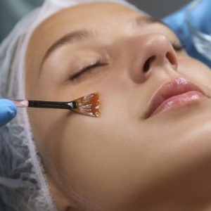 Chemical-Peel